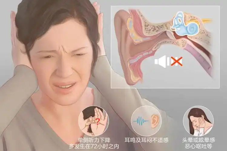 又称特发性突聋,指在72小时内突然出现的,原因不明的听力下降