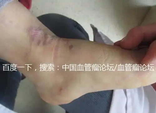 血管瘤论坛文献弥漫性淋巴管瘤这是一种罕见的淋巴管瘤特殊类型