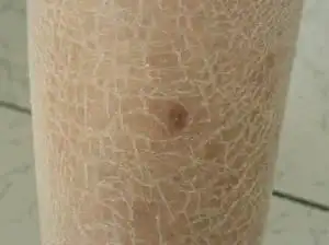 皮肤眼睛口都干小心是干燥症女性罹病率是男性的35倍