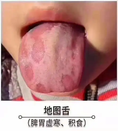 教你看小儿舌苔辨别问题所在