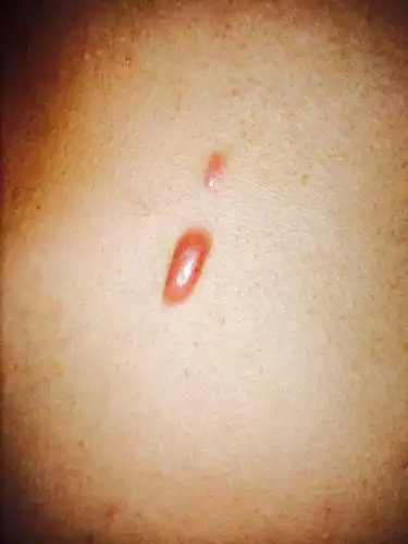 胸口凸起一片小包不疼不痒不知道是什么东西,没时候去医院看,帮帮我