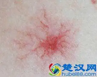 红血丝形成的原因