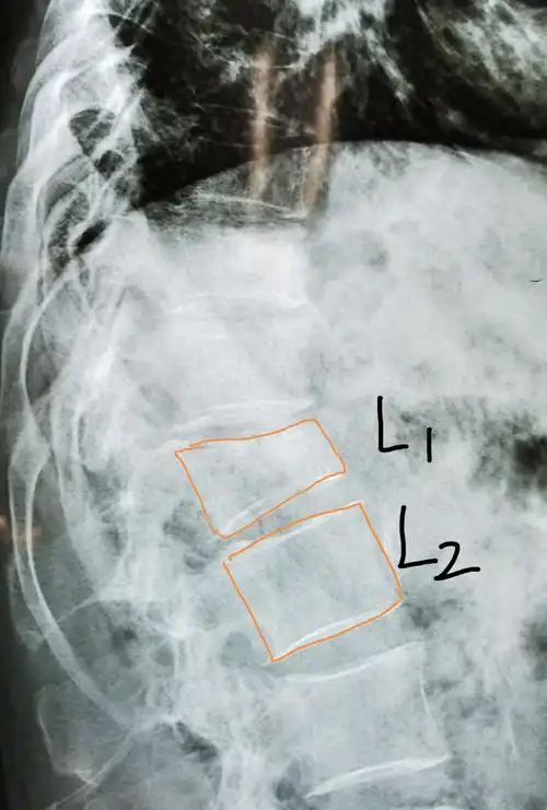 腰椎平片提示腰1椎体前缘压缩有二分之一,侧位片非常明显,且腰椎ct