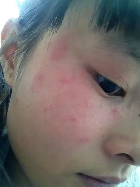 一点作用都没起反而越来越多,现在眼皮上,脸上都是,  我面部皮肤过敏