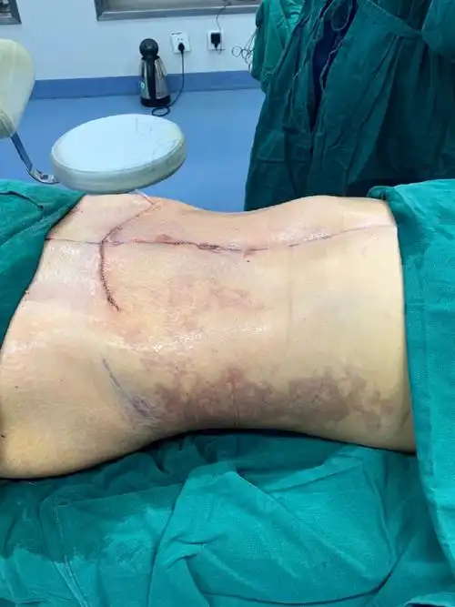 【人鱼体雕腰腹马甲线 腹部拉皮吸脂塑形】