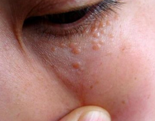 汗管瘤图片眼部图片 (4)