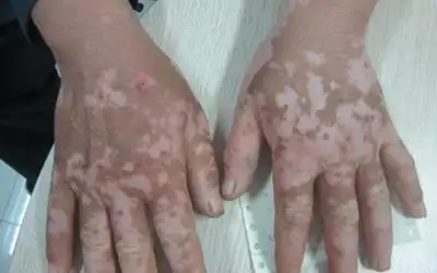 手上白斑的症状图片长什么样子