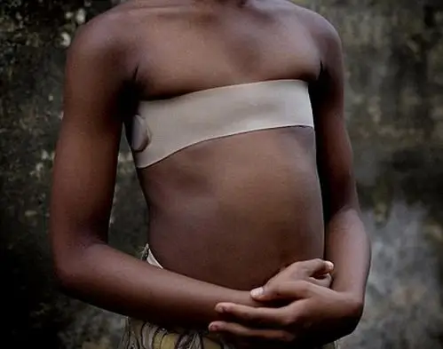 太可怕了, 为防性侵毁掉女孩乳房