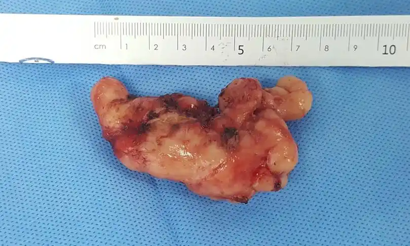 瑞金胸外食管良性肿瘤不用愁机器人手术大显身手