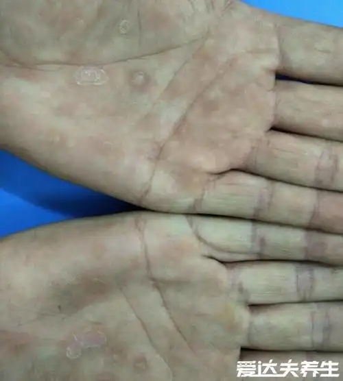 梅毒疹图片及症状(梅毒梅毒疹图片大全) - 婴儿梅毒疹子图片 - 实验室