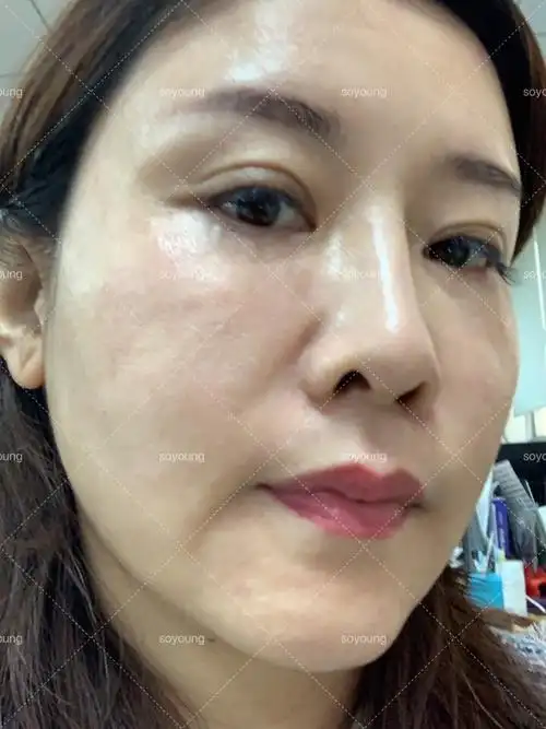 做完光子嫩肤的第一天,效果很不错,我主要是去红血丝_圈子-新氧美容