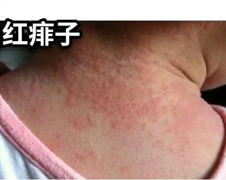 4楼 这是典型的红痱子,热疹都是凸出皮肤表面的,摸上去有颗粒感