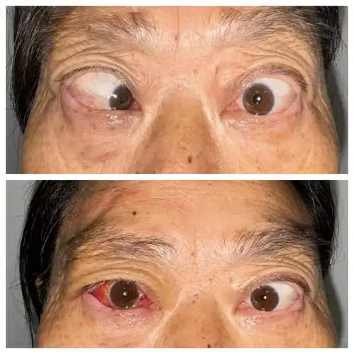 探索眼科术式,为追逐光明不断前行 --宣汉县人民医