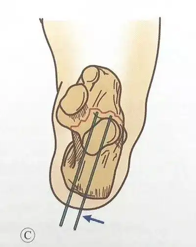 微创入路跟骨舌状骨折闭合复位内固定术 - 上海开为医药科技有限公司