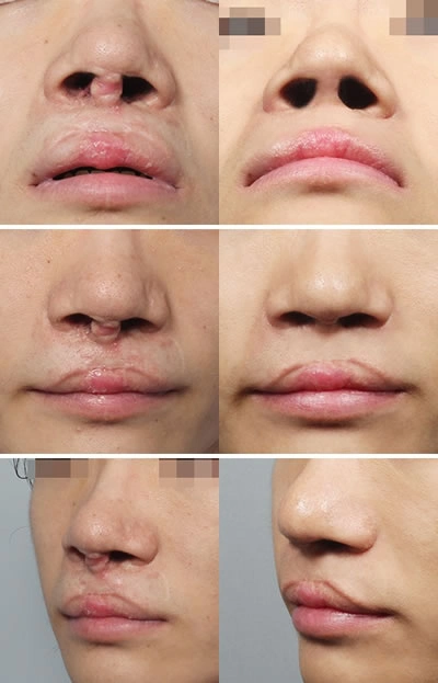 韩国mvp整形医院唇裂兔唇矫正案例对比图