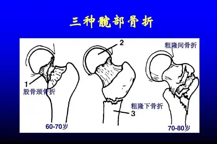 三种髋部骨折 粗隆间骨折 股骨颈骨折 粗隆下骨折 60-70岁 70-80岁