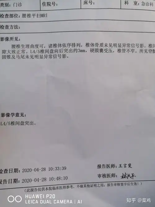 腰间盘突出 - 知乎