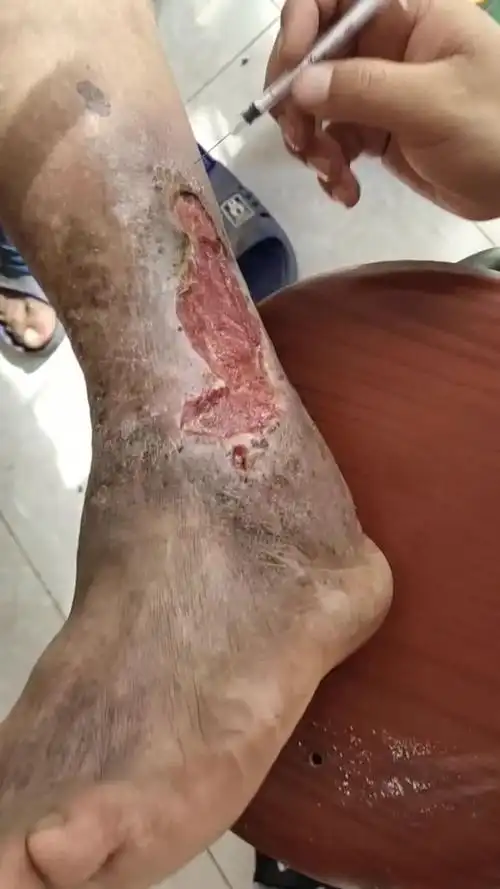小腿溃烂,仅仅两月时间,溃烂到如此程度!