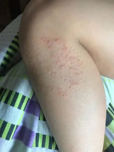 孩子身上起了一堆不疼不痒的疹子