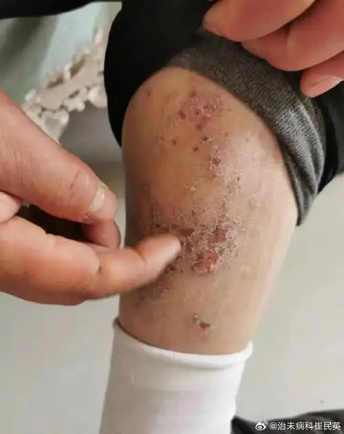 中医##湿疹##微博健康公开课