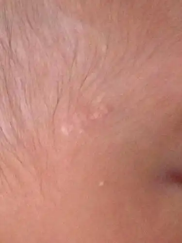 宝宝出生时就有,类似脂肪粒堆积在一起,不知道是什么,会不会消失?