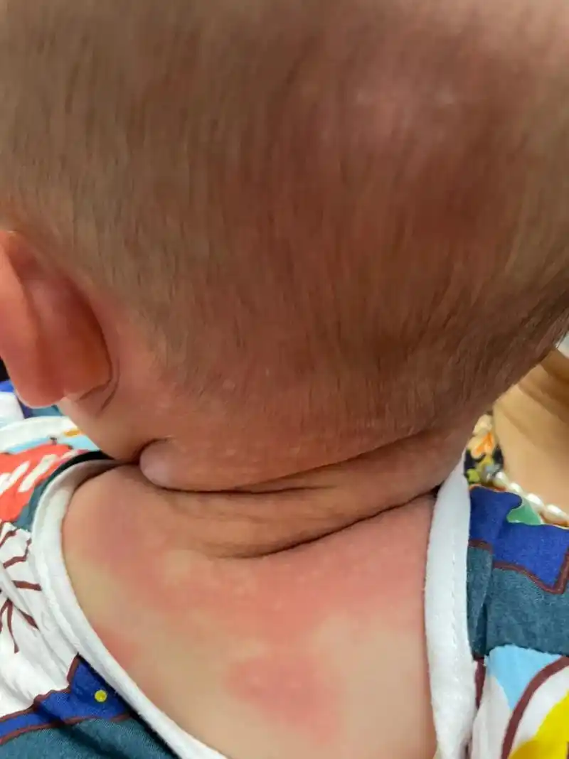 晚上11点半给宝宝涂痱子药水时,朦胧的夜灯下发现脖子一圈红疙 - 抖音