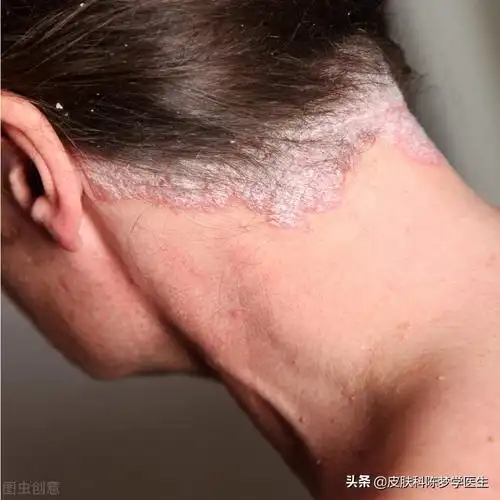 银屑病(牛皮癣)有三大特征,你知道吗?