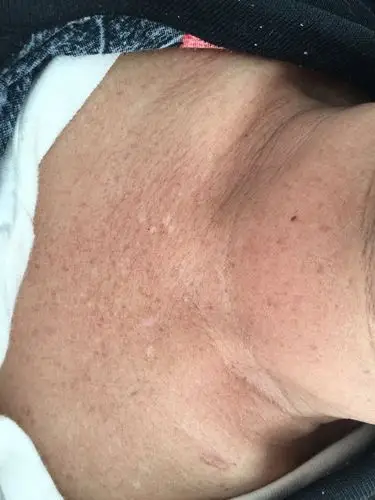 前胸及腹壁可见斑点状色素脱失,形成黑白相间改变,称"椒盐征".