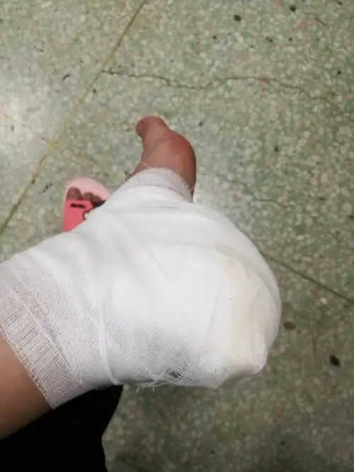 在租的新房间打扫卫生,水池老化被我压碎了,脚划伤,缝针打包花了一千