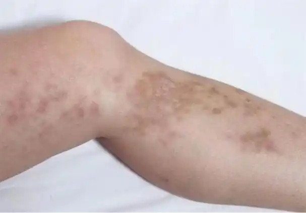 医生:小腿上出现这种斑,预示着糖尿病并发症,千万要提高警惕!