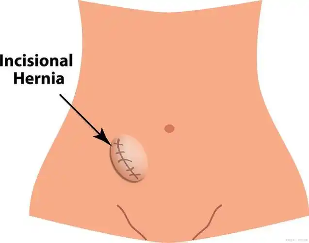 腹壁疝手术前能吃东西吗?原因为何?