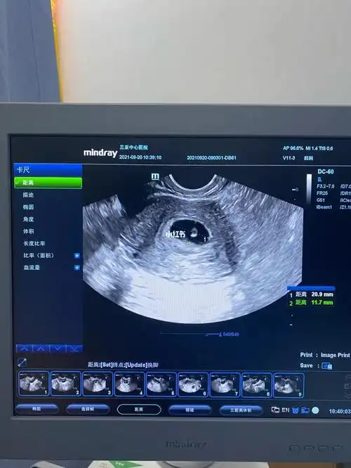 孕6周已见胎心胎芽