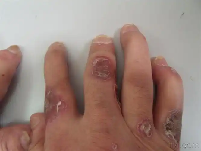 关节型银屑病门诊照片