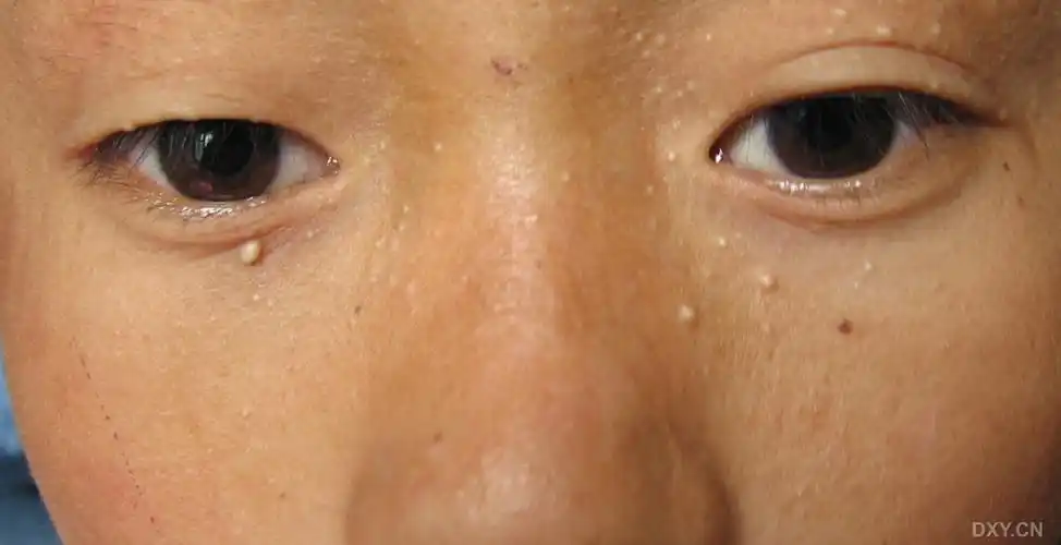 【请教】家族性粟丘疹