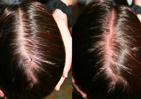女性掉头发厉害是什么原因 - 脱发人tuofaren