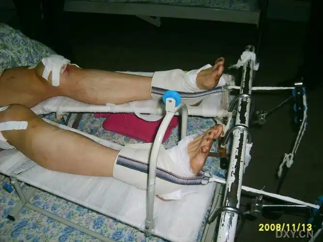 右股骨髁 胫骨平台骨折/ /左髌骨 胫骨平台骨折