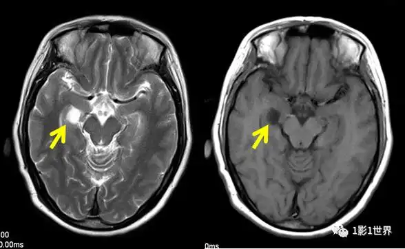 影像报告解读:脉络裂囊肿