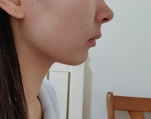 深覆合,下巴后缩