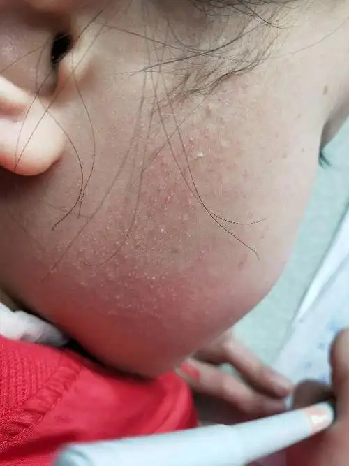 宝宝八岁了,脸上长了这么多,不知道是什么东西,求你们指点一下.