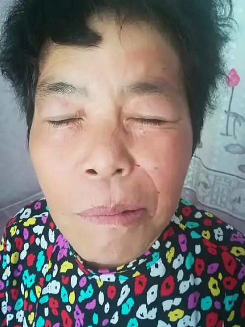 面瘫病例