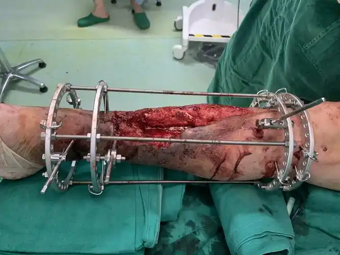 胫骨慢性骨髓炎,胫骨延长搬运术