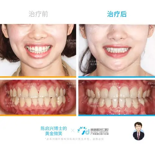 龅牙露龈笑牙齿矫正案例