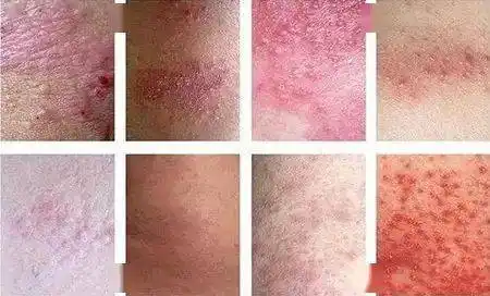 【南宁天伦】| 怎样辨别"外阴湿疹"和"外阴白斑"_患者_病情_治疗