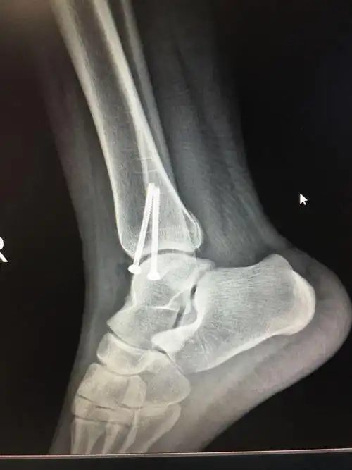 右内踝骨折提前三天口服艾瑞昔布100mgbid