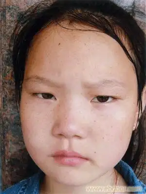 脸上雀斑怎么祛掉