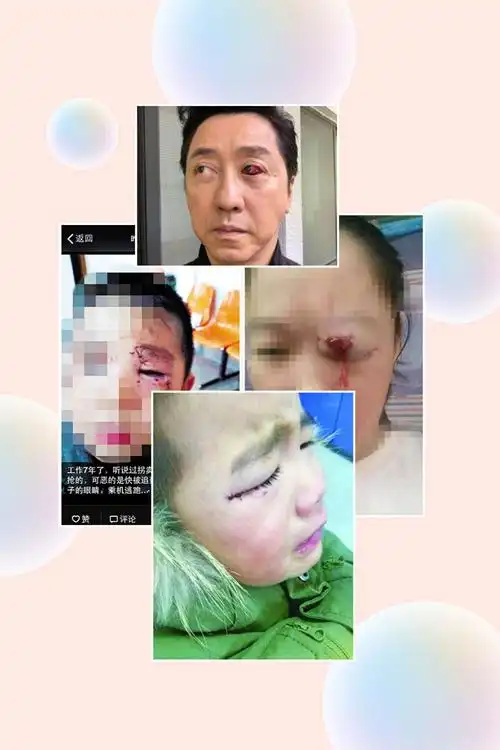 他们的眼睛受伤好严重好严重吖