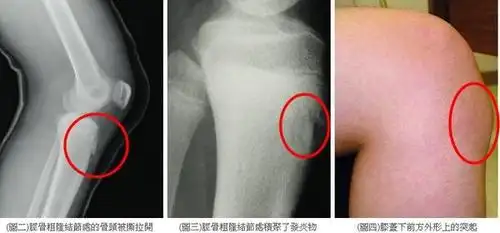 在诸多运动后引起膝关节痛的疾病当中,其中有一种临床上称为"胫骨结节