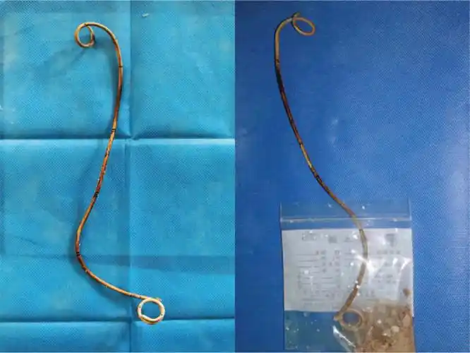 留置输尿管支架导致膀胱结石