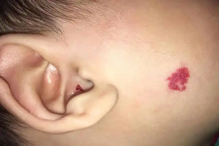 面部毛细血管瘤图