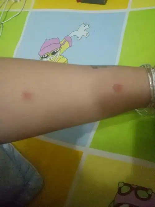 养狗之后身上有红疙瘩